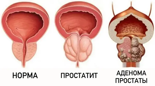 Изображение воспаленной простаты